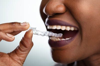 woman putting in her new Invisalign clear aligners